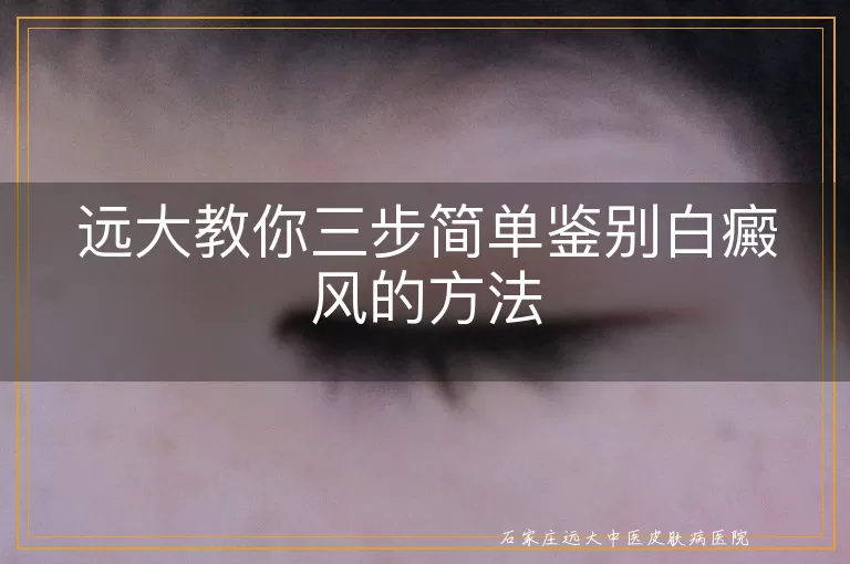 远大教你三步简单鉴别白癜风的方法