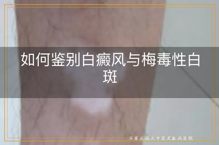 如何鉴别白癜风与梅毒性白斑