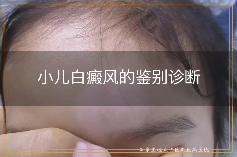 小儿白癜风的鉴别诊断