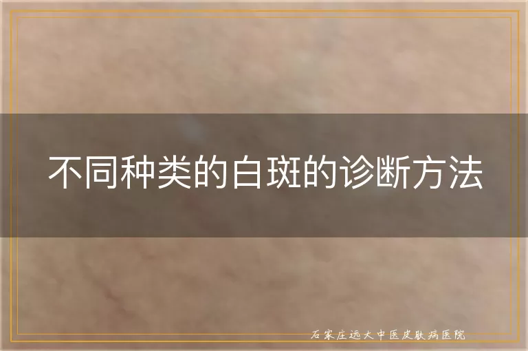 不同种类的白斑的诊断方法