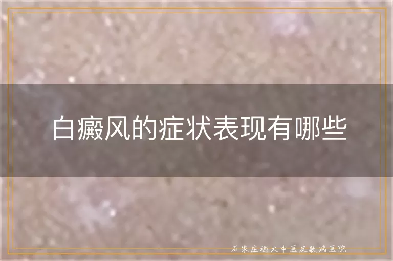 白癜风的症状表现有哪些