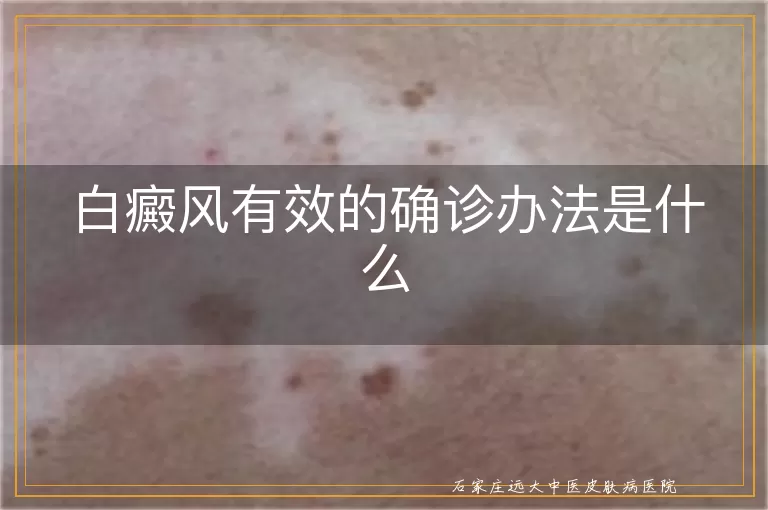 白癜风有效的确诊办法是什么