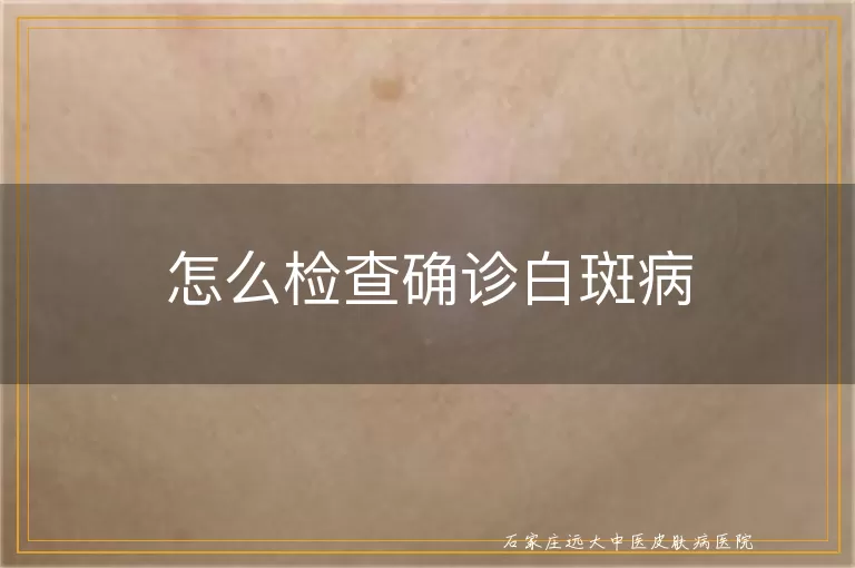 怎么检查确诊白斑病
