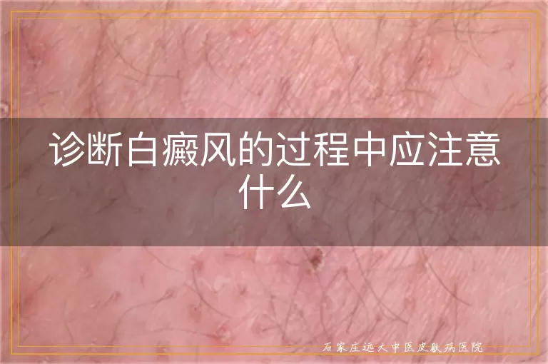 诊断白癜风的过程中应注意什么