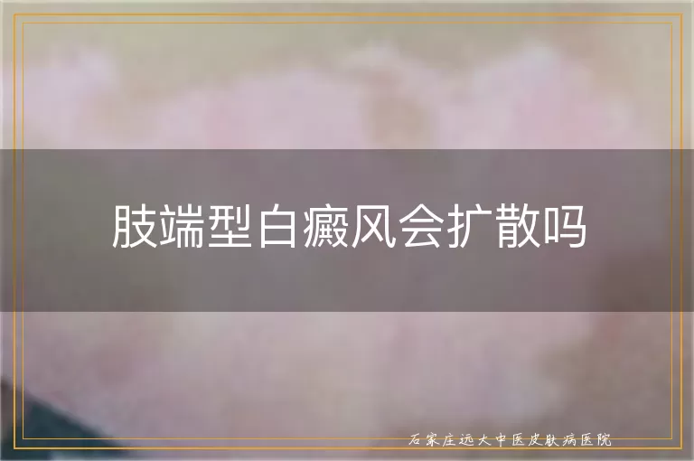 肢端型白癜风会扩散吗