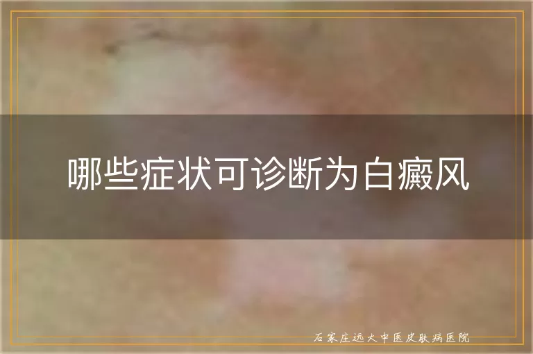 哪些症状可诊断为白癜风