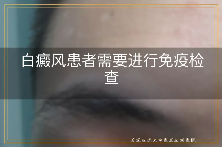 白癜风患者需要进行免疫检查