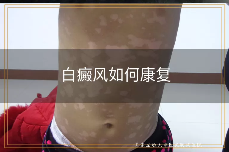 白癜风如何康复