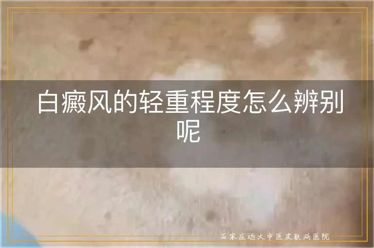 白癜风的轻重程度怎么辨别呢