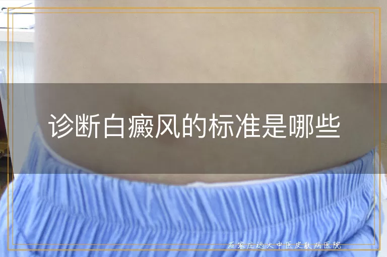 诊断白癜风的标准是哪些