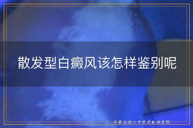 散发型白癜风该怎样鉴别呢