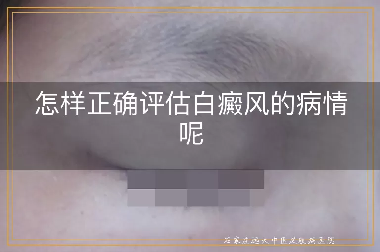 怎样正确评估白癜风的病情呢
