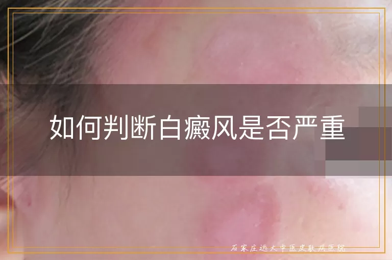 如何判断白癜风是否严重