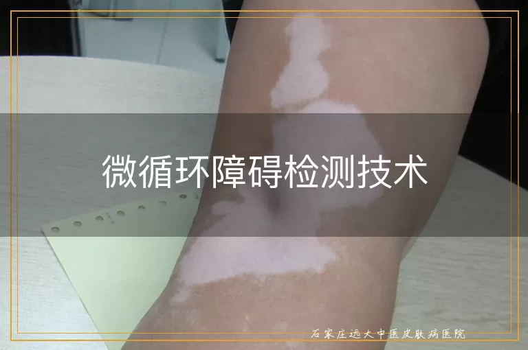 微循环障碍检测技术