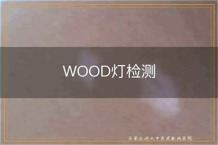 WOOD灯检测
