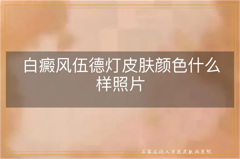 白癜风伍德灯皮肤颜色什么样照片