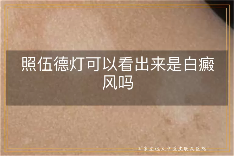 照伍德灯可以看出来是白癜风吗
