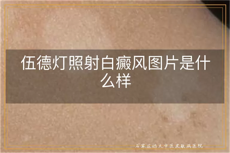 伍德灯照射白癜风图片是什么样
