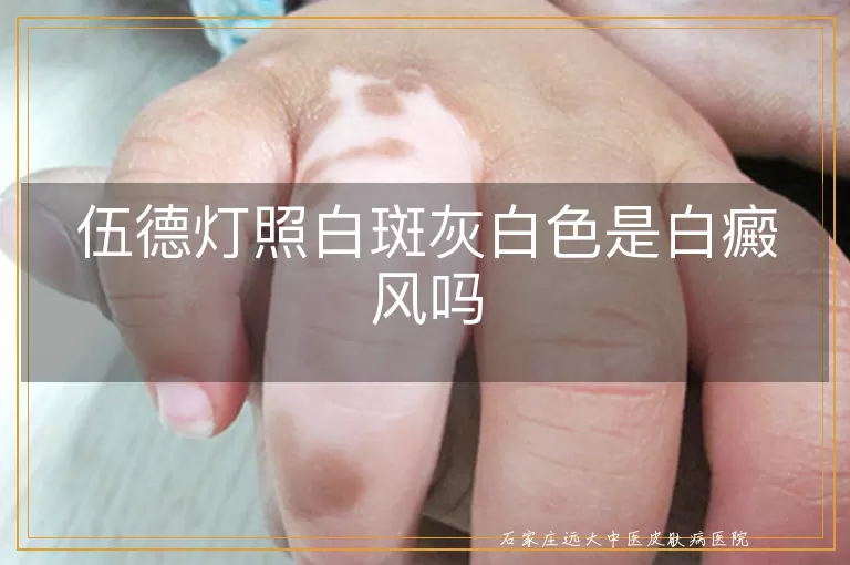 伍德灯照白斑灰白色是白癜风吗