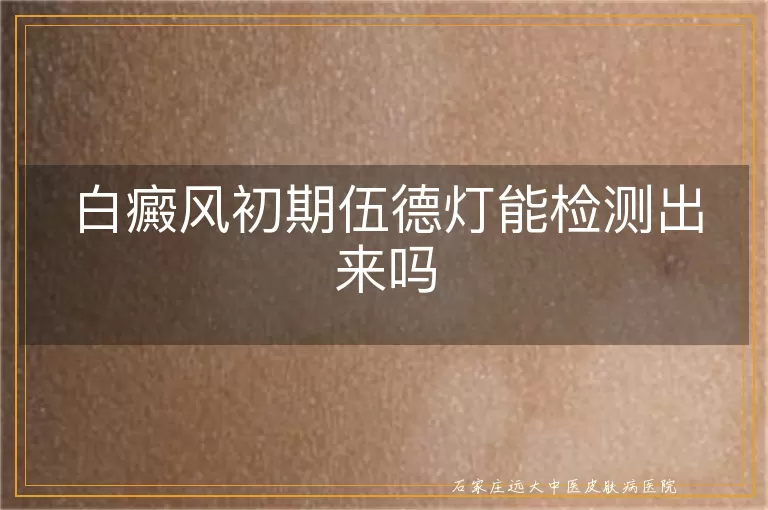 白癜风初期伍德灯能检测出来吗