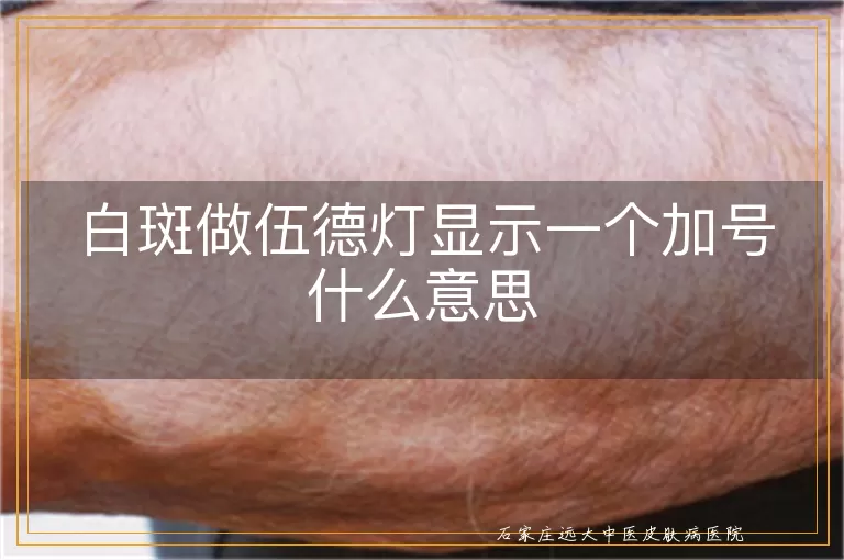 白斑做伍德灯显示一个加号什么意思