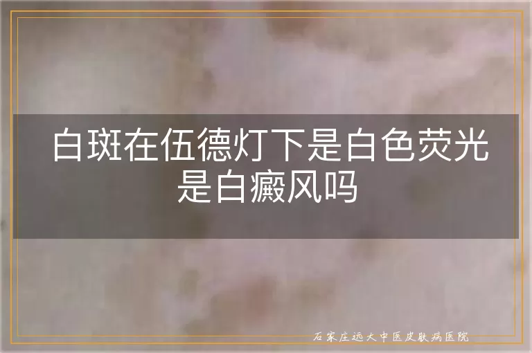 白斑在伍德灯下是白色荧光是白癜风吗