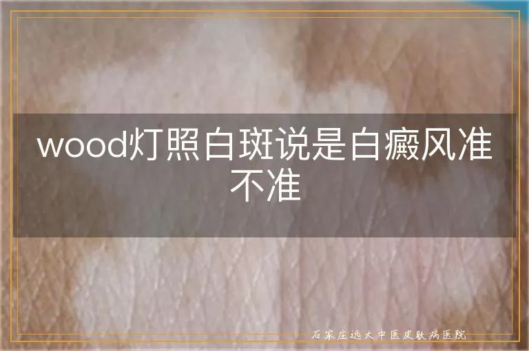 wood灯照白斑说是白癜风准不准