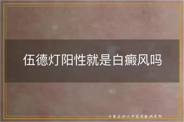 伍德灯阳性就是白癜风吗
