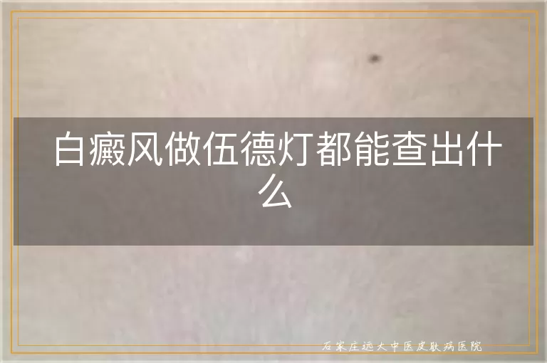 白癜风做伍德灯都能查出什么