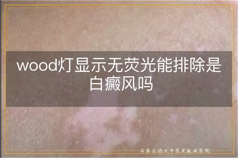 wood灯显示无荧光能排除是白癜风吗