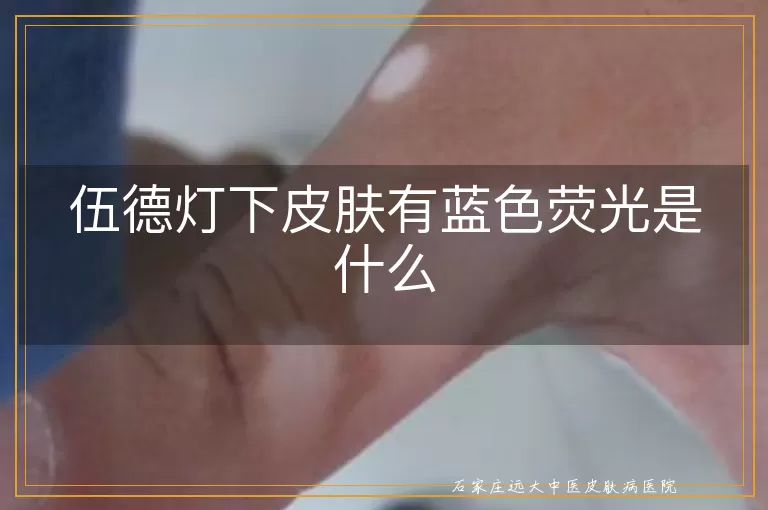 伍德灯下皮肤有蓝色荧光是什么
