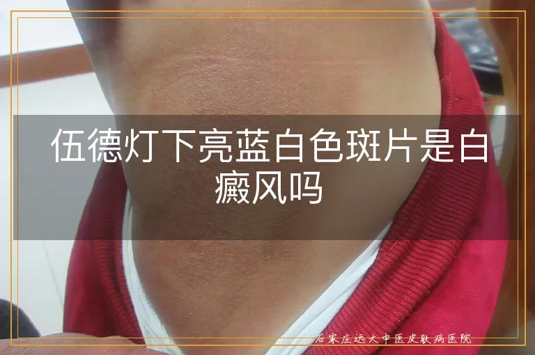 伍德灯下亮蓝白色斑片是白癜风吗
