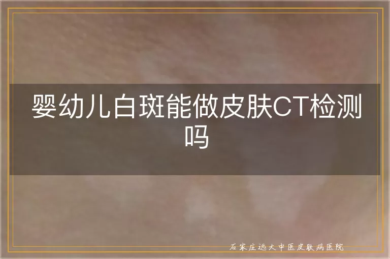 婴幼儿白斑能做皮肤CT检测吗