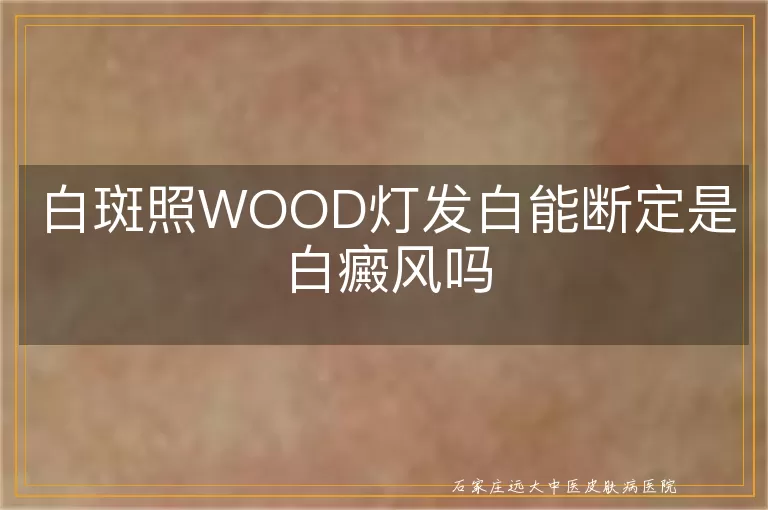 白斑照WOOD灯发白能断定是白癜风吗