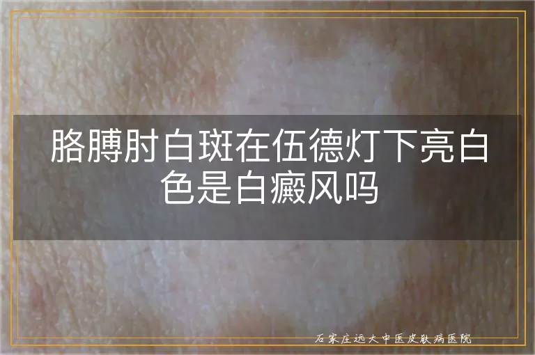 胳膊肘白斑在伍德灯下亮白色是白癜风吗