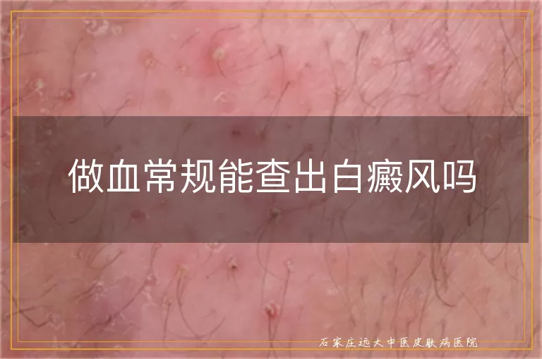 做血常规能查出白癜风吗