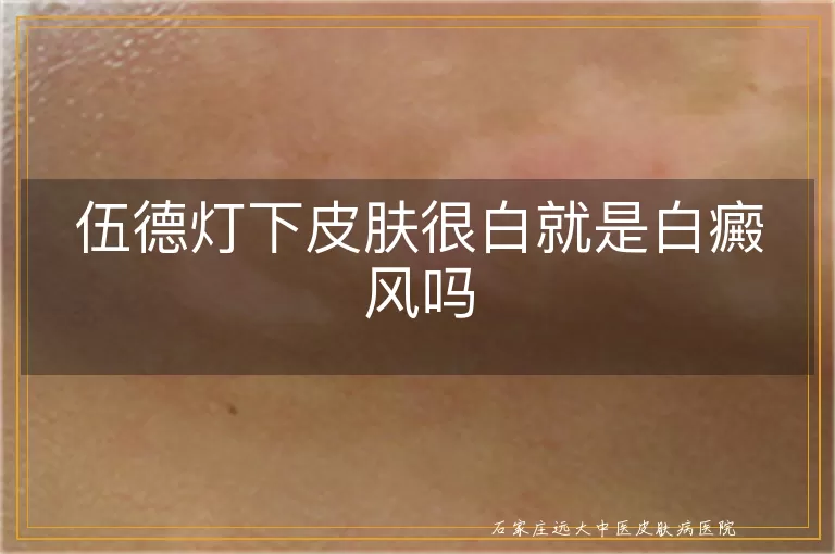 伍德灯下皮肤很白就是白癜风吗