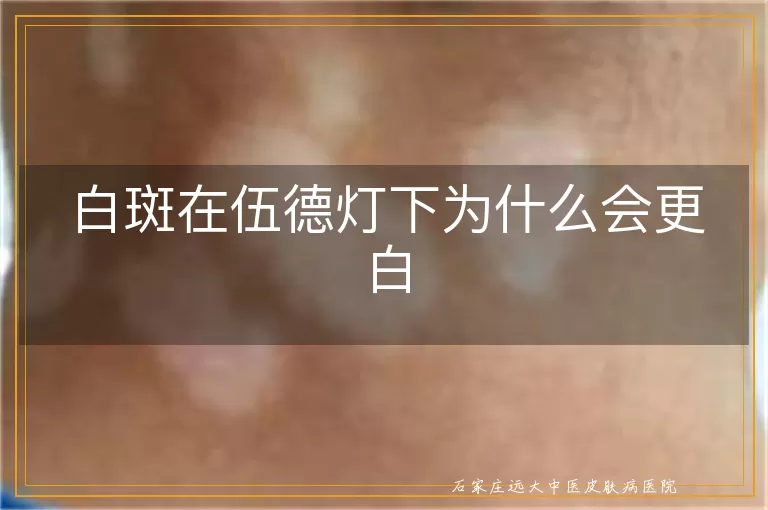 白斑在伍德灯下为什么会更白