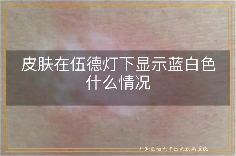 皮肤在伍德灯下显示蓝白色什么情况