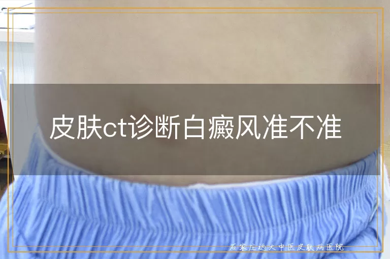 皮肤ct诊断白癜风准不准