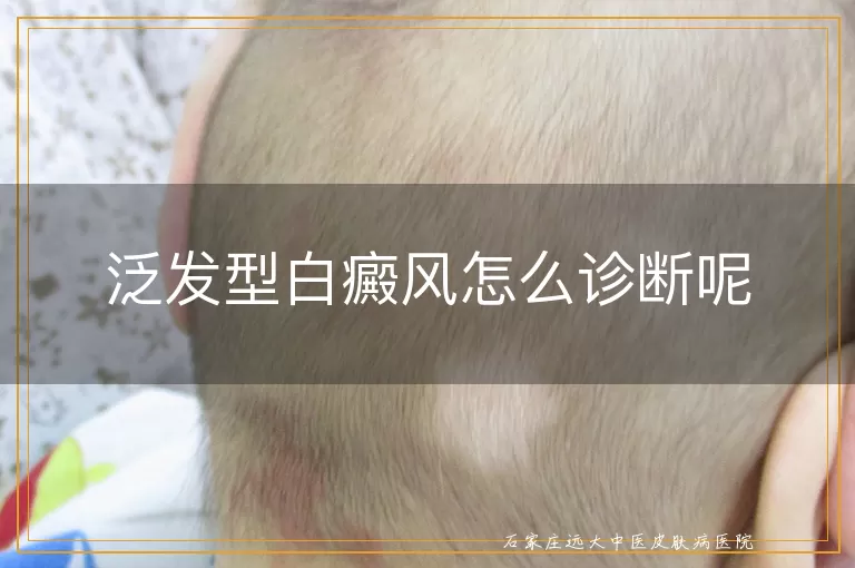 泛发型白癜风怎么诊断呢