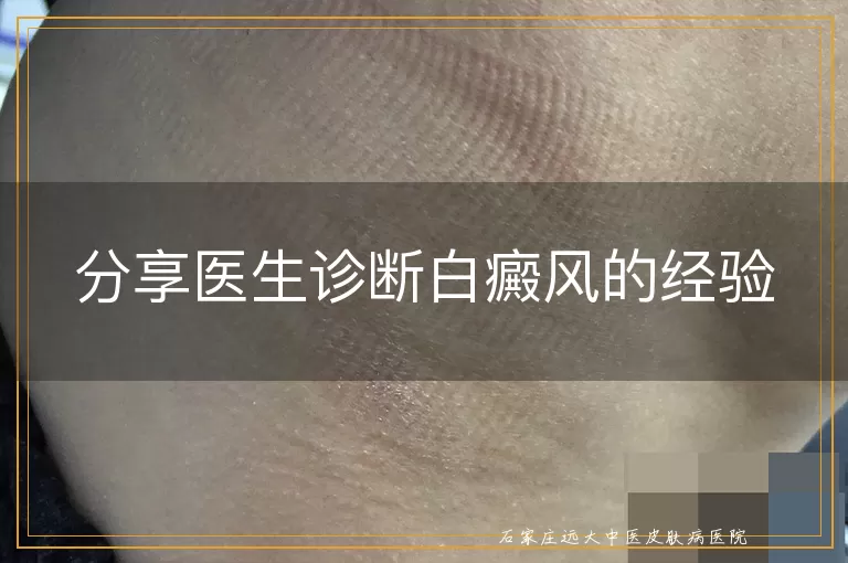 分享医生诊断白癜风的经验