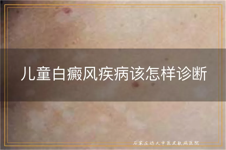 儿童白癜风疾病该怎样诊断