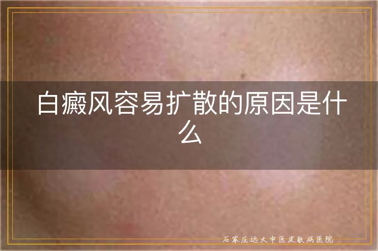 白癜风容易扩散的原因是什么