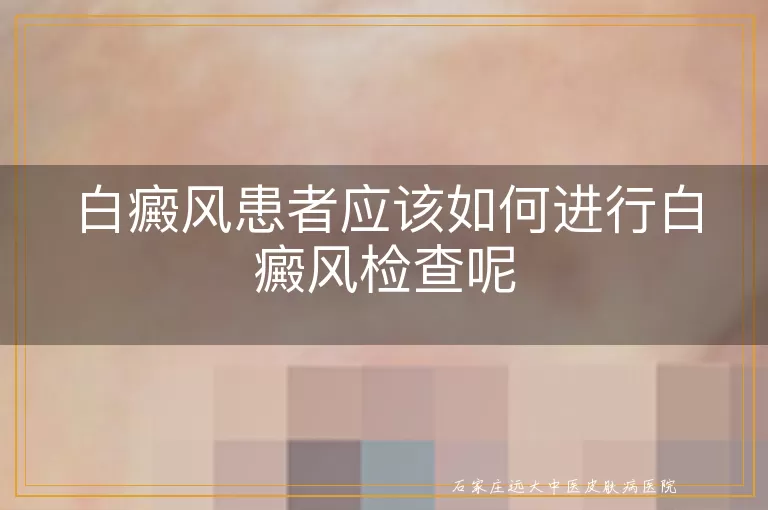 白癜风患者应该如何进行白癜风检查呢