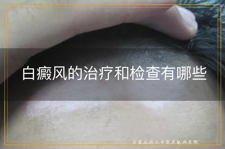 白癜风的治疗和检查有哪些