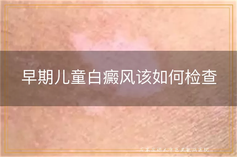 早期儿童白癜风该如何检查