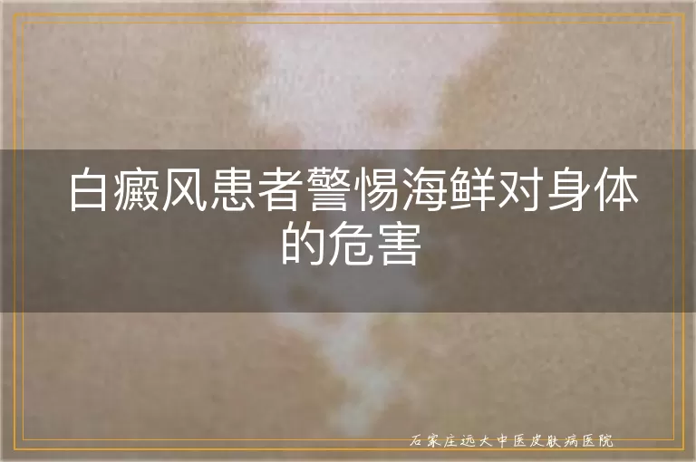 白癜风患者警惕海鲜对身体的危害