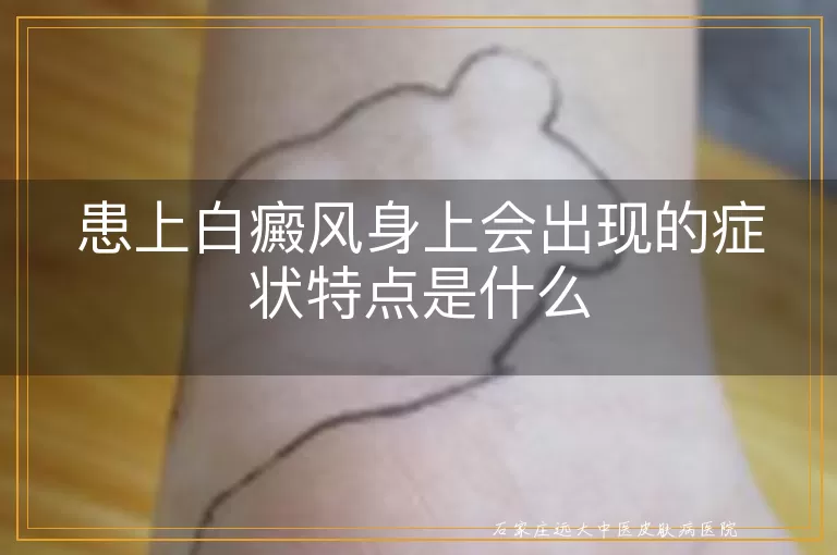 患上白癜风身上会出现的症状特点是什么