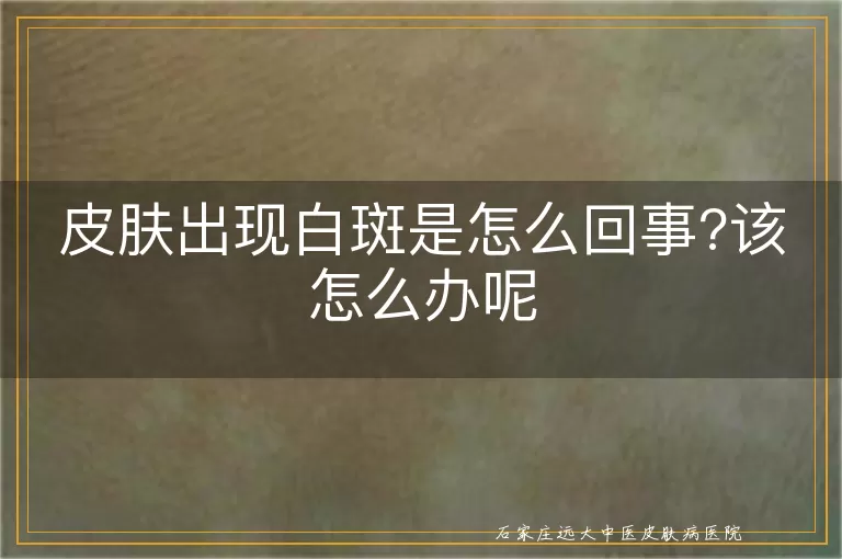 皮肤出现白斑是怎么回事?该怎么办呢